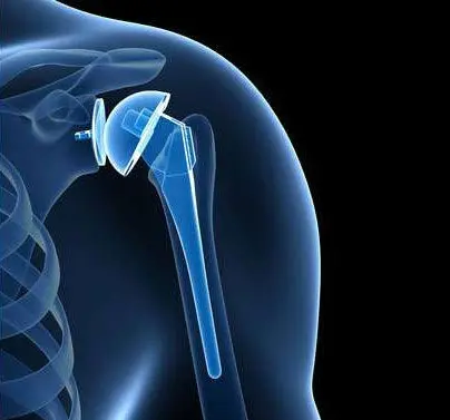What is Shoulder Prosthesis? When is it applied?