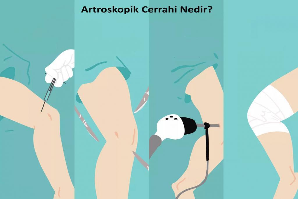 Artroskopik Cerrahi Nedir?