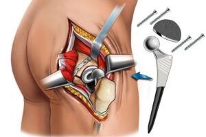 What is a Hip Fracture?