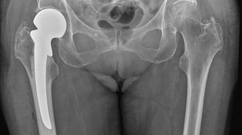 What is a Hip Fracture?