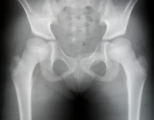 What is Hip Dislocation?