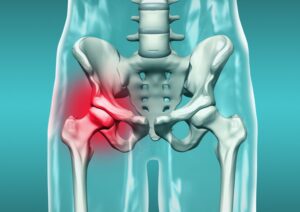 What is Hip Dislocation?