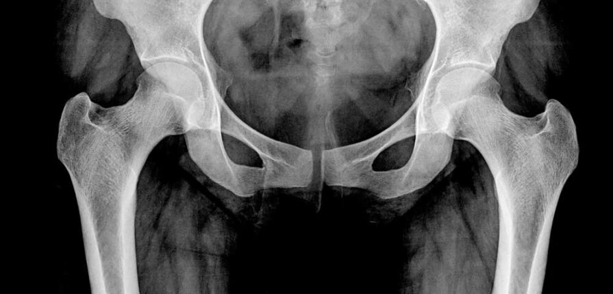 What is Hip Dislocation?